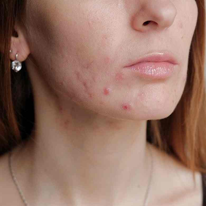 What Are Blemishes?